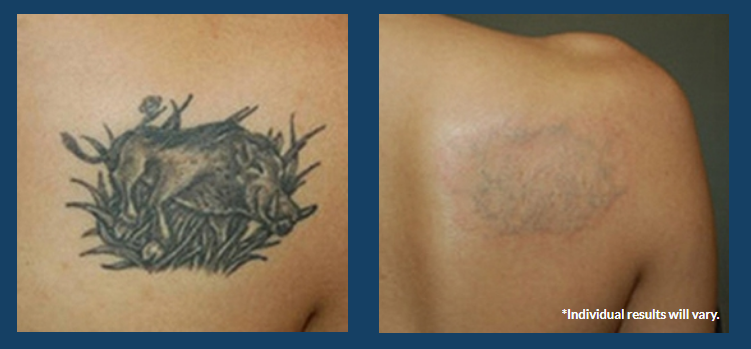 faster laser tattoo removal｜TikTok Search