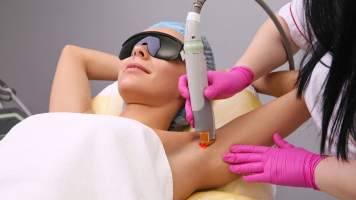 laser hair removal