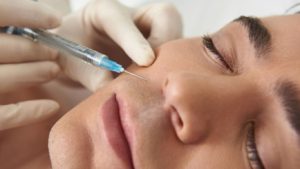 dermal fillers for smile lines