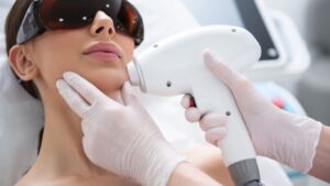 laser hair removal on face