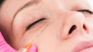 undereye dermal fillers