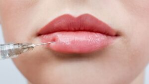 dermal fillers for lips